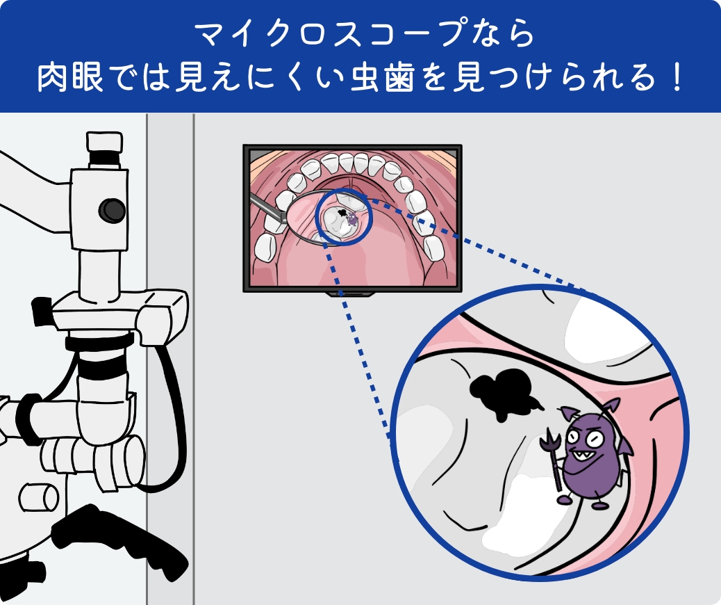 マイクロスコープなら肉眼では見えにくい虫歯を見つけられる!